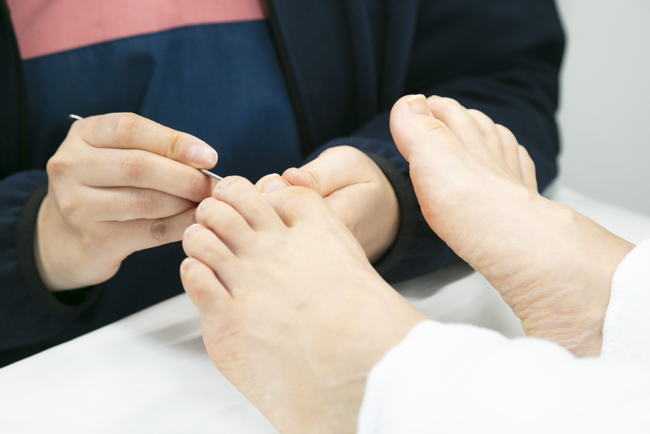 茅ヶ崎市　巻き爪　施術