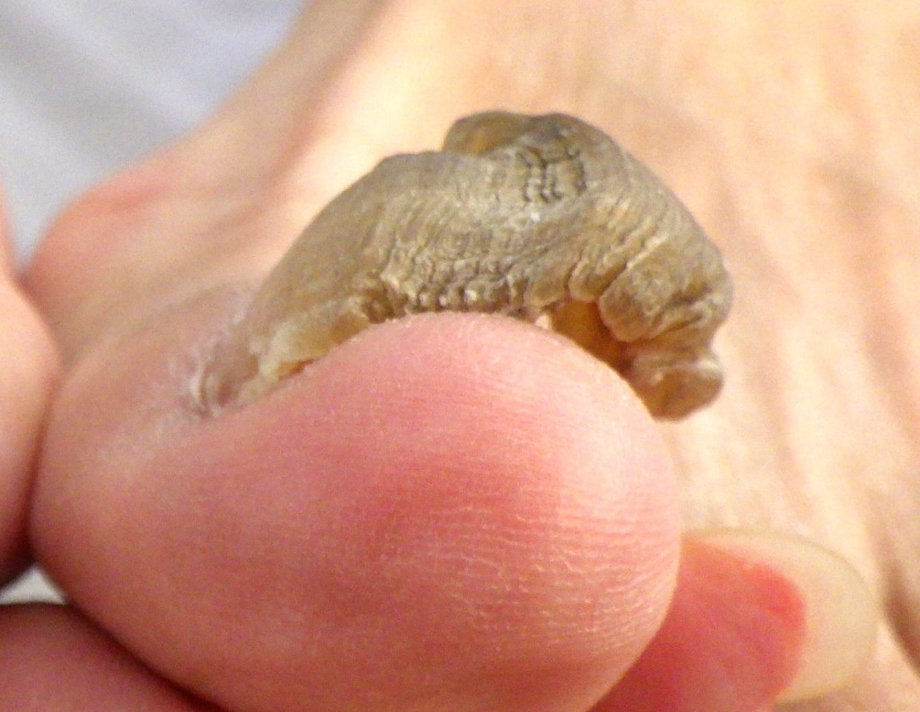  茅ケ崎市　巻き爪　ビフォー