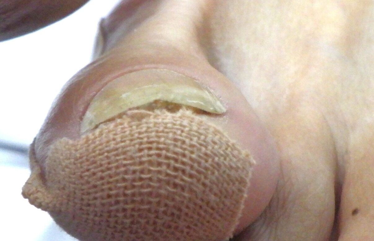 茅ヶ崎市　巻き爪　アフター