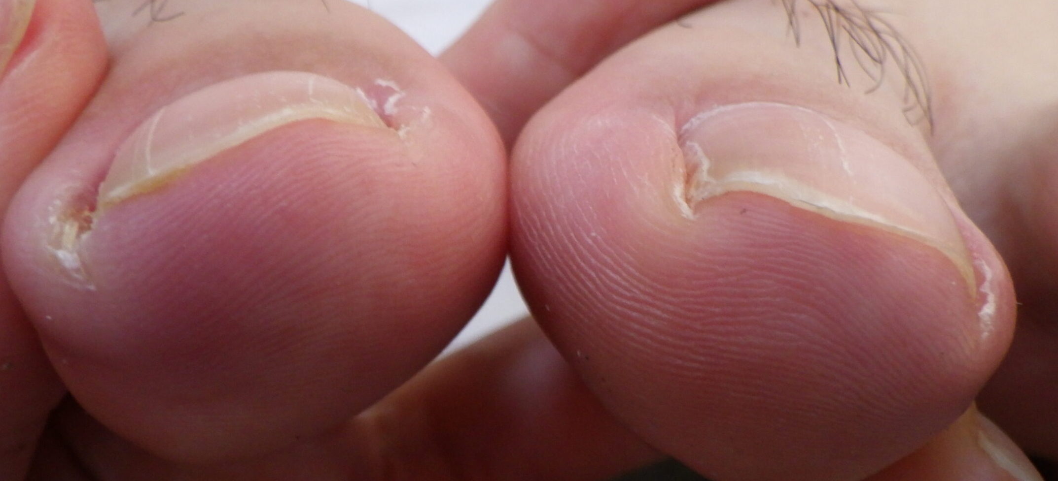  茅ケ崎市　巻き爪　ビフォー