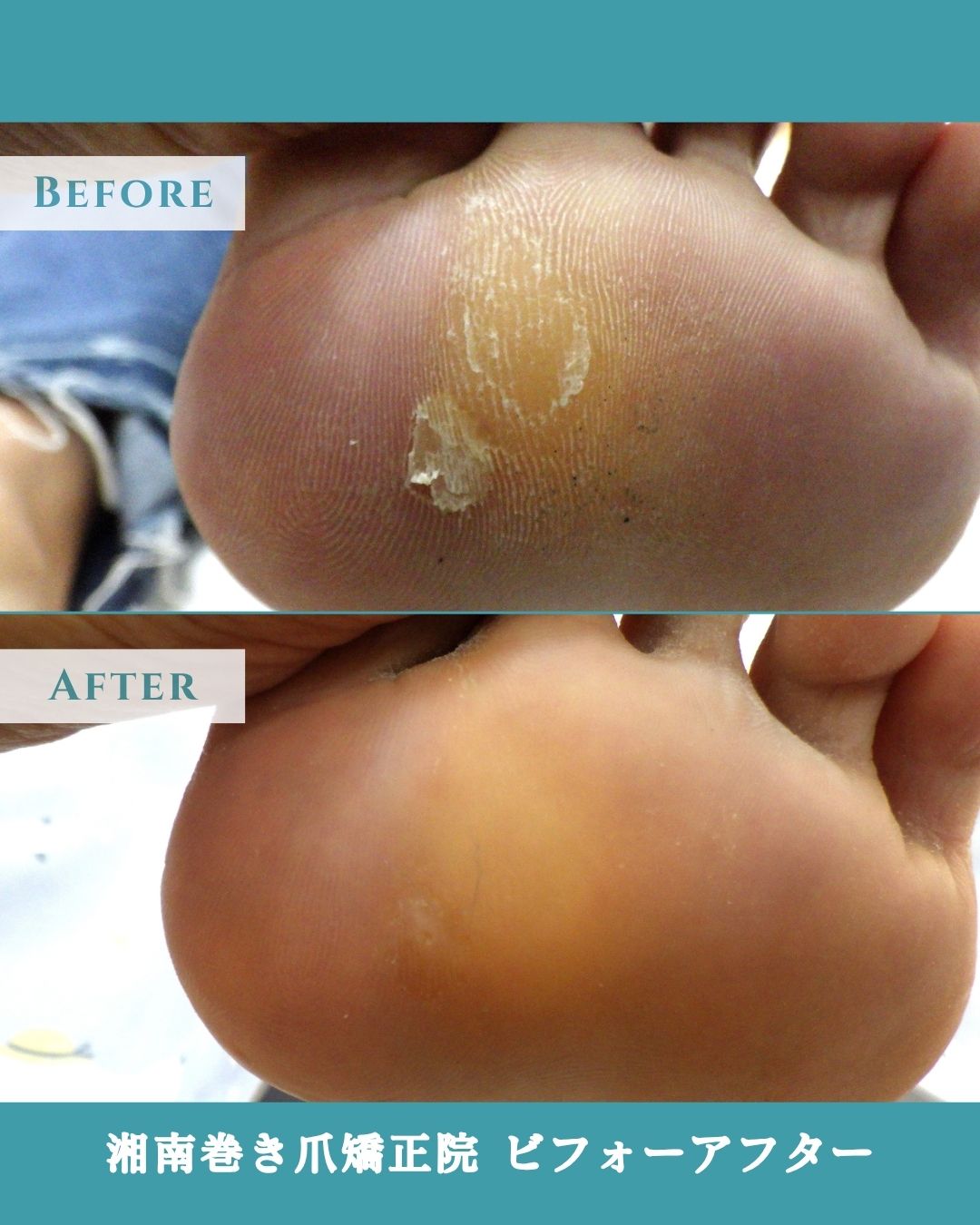 茅ヶ崎市　巻き爪　足