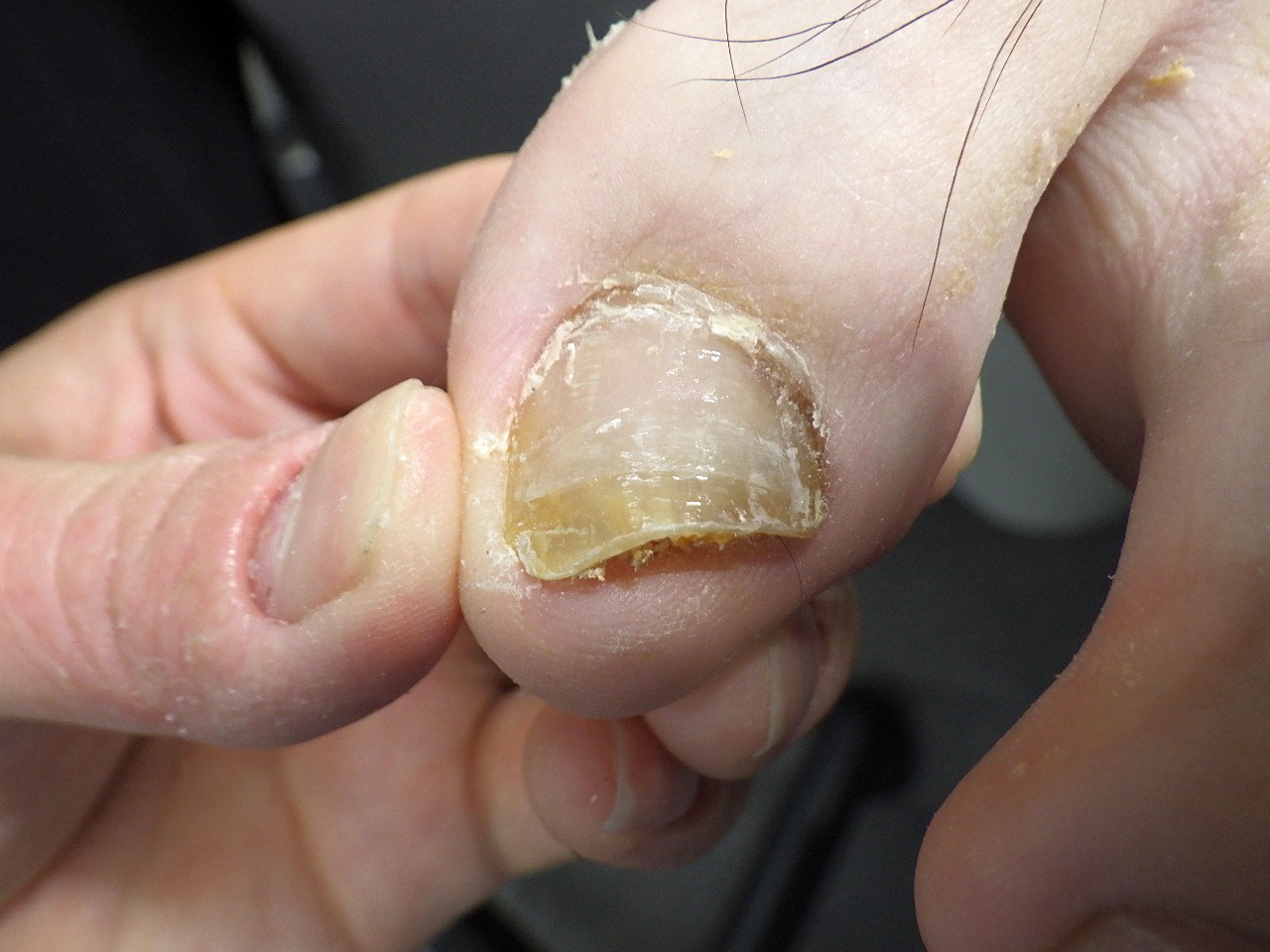 相模原市橋本 巻き爪 アフター