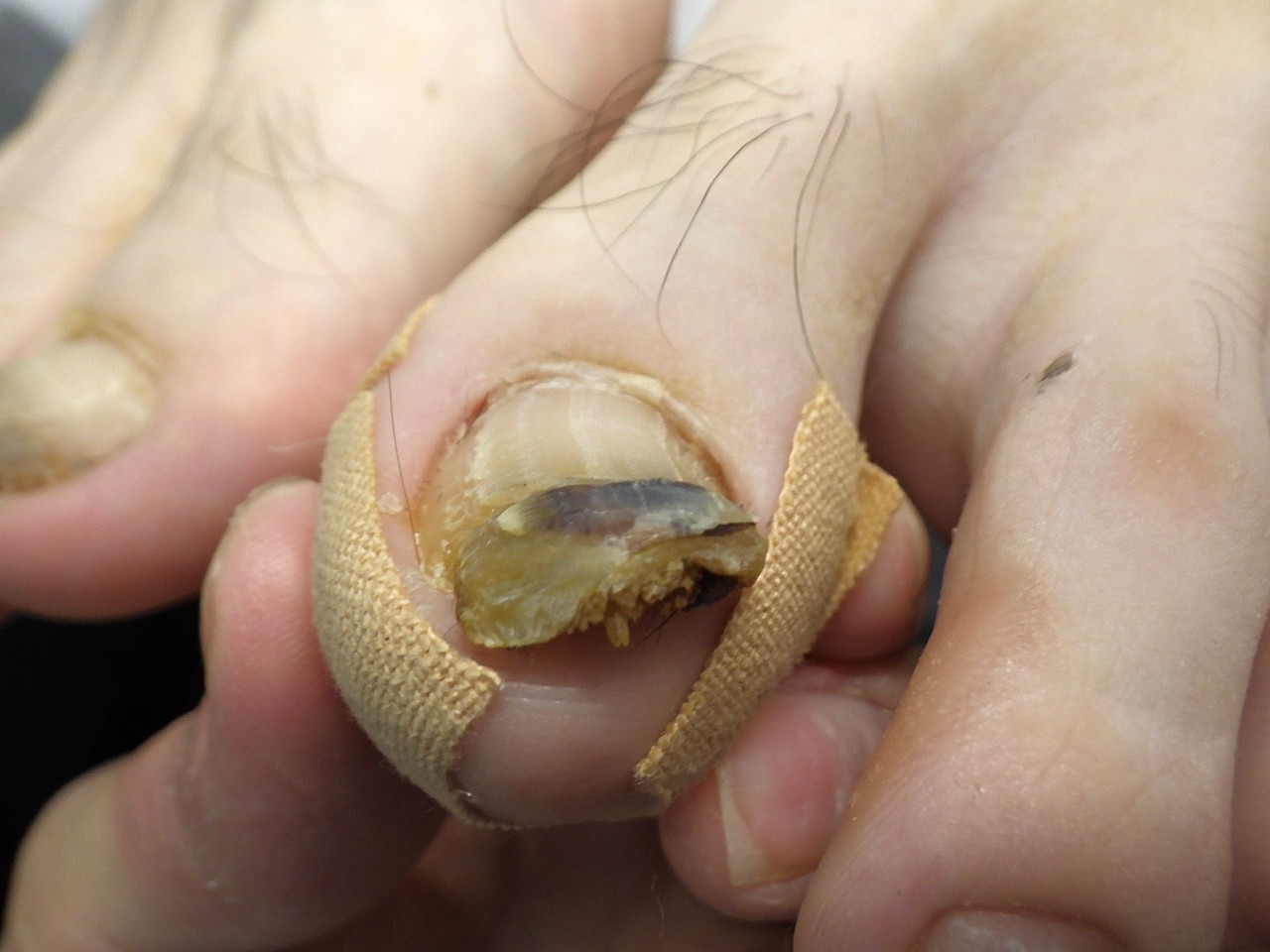 相模原市橋本 巻き爪 ビフォー