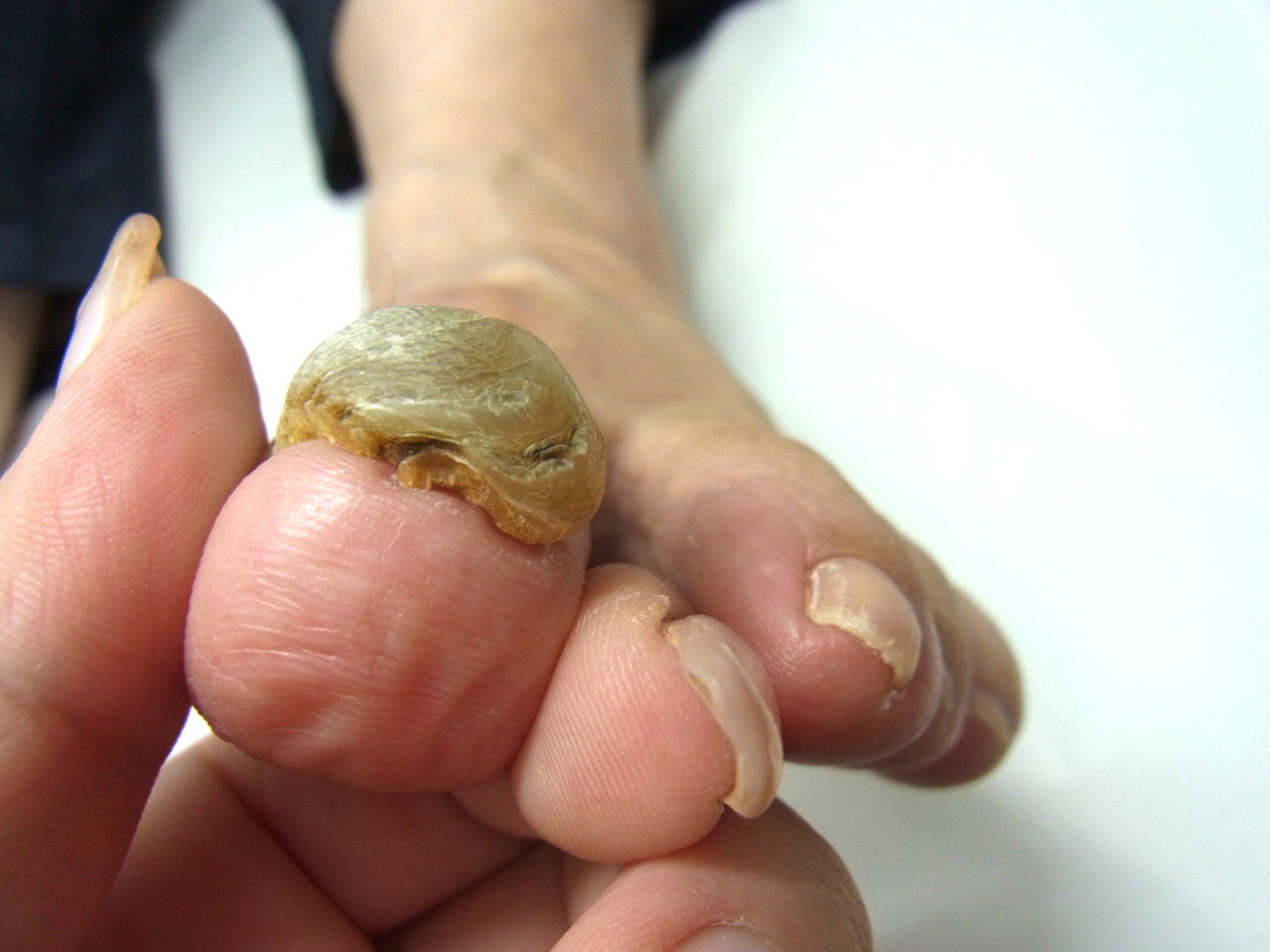  相模原市橋本　巻き爪　ビフォー