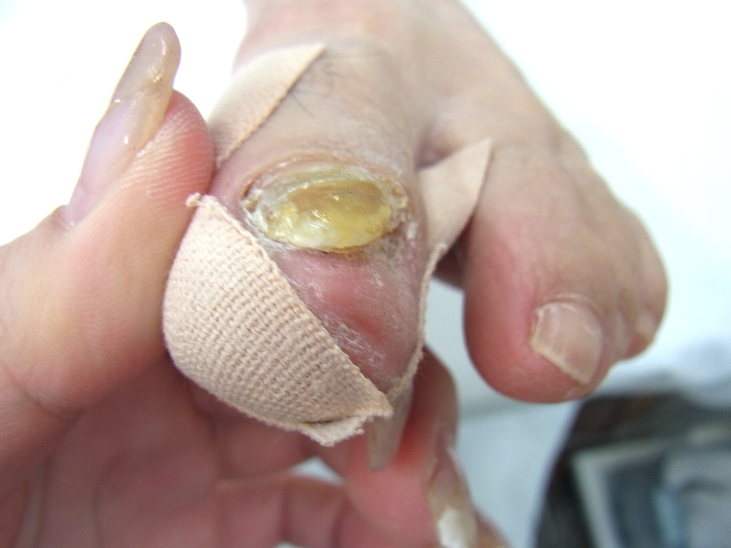 相模原市橋本　巻き爪　アフター