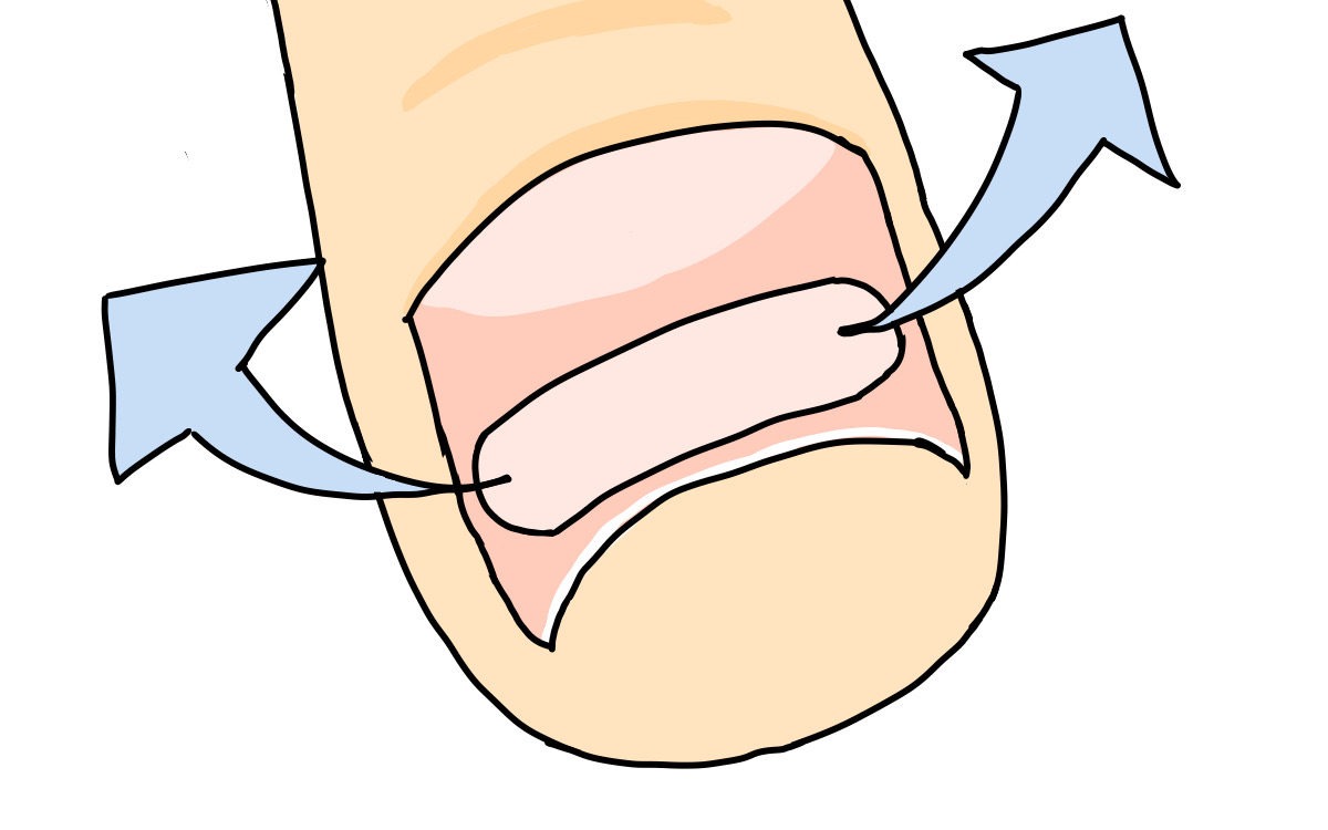 相模原市橋本　巻き爪　プレート