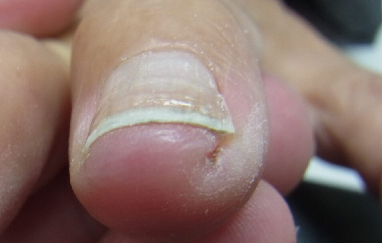 相模原市橋本　巻き爪　アフター