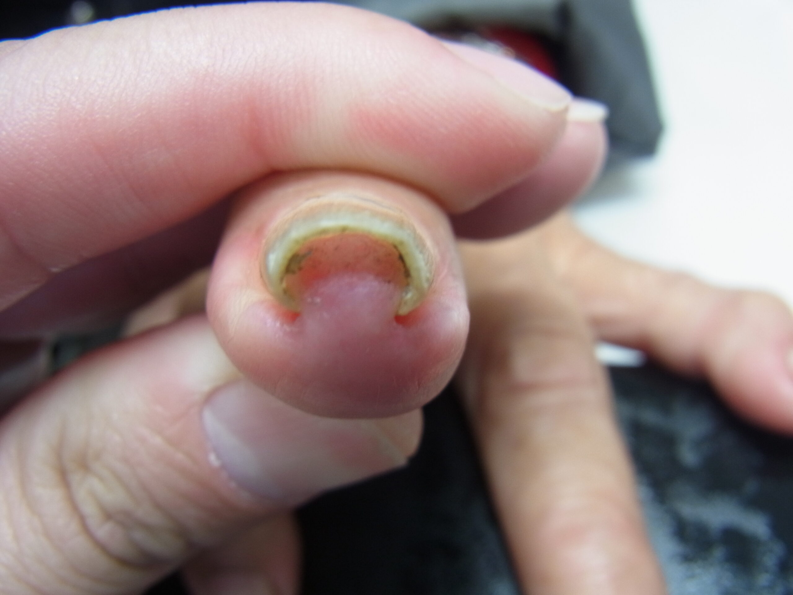  相模原市橋本　巻き爪　ビフォー