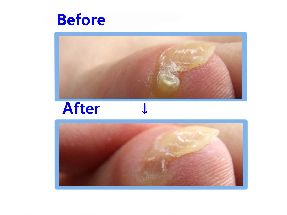 相模原市橋本　巻き爪　副爪