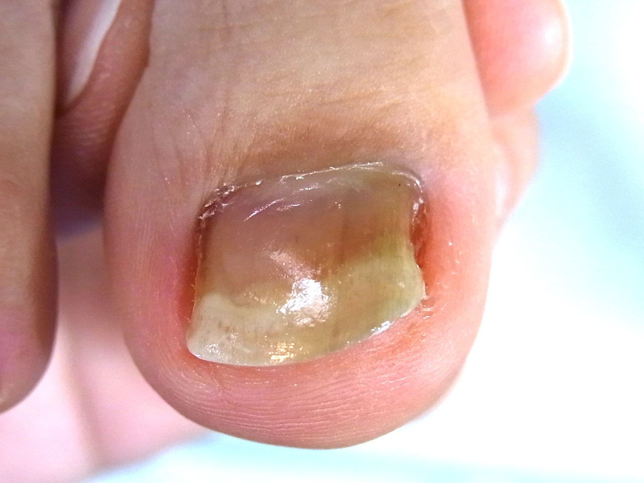 平塚市　巻き爪　アフター