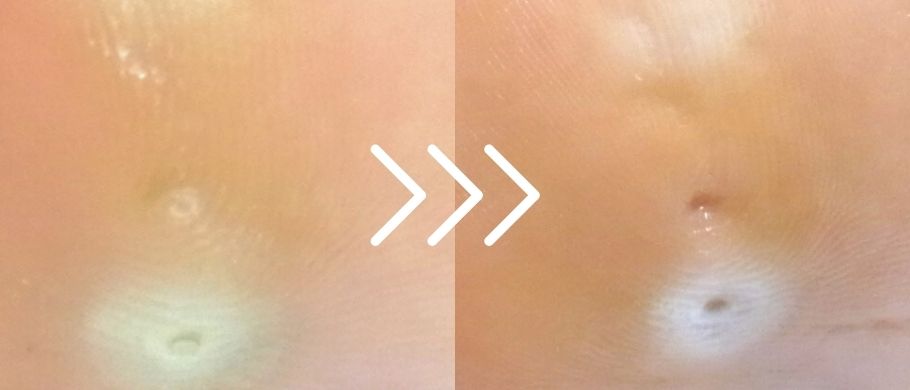 平塚市 巻き爪 魚の目