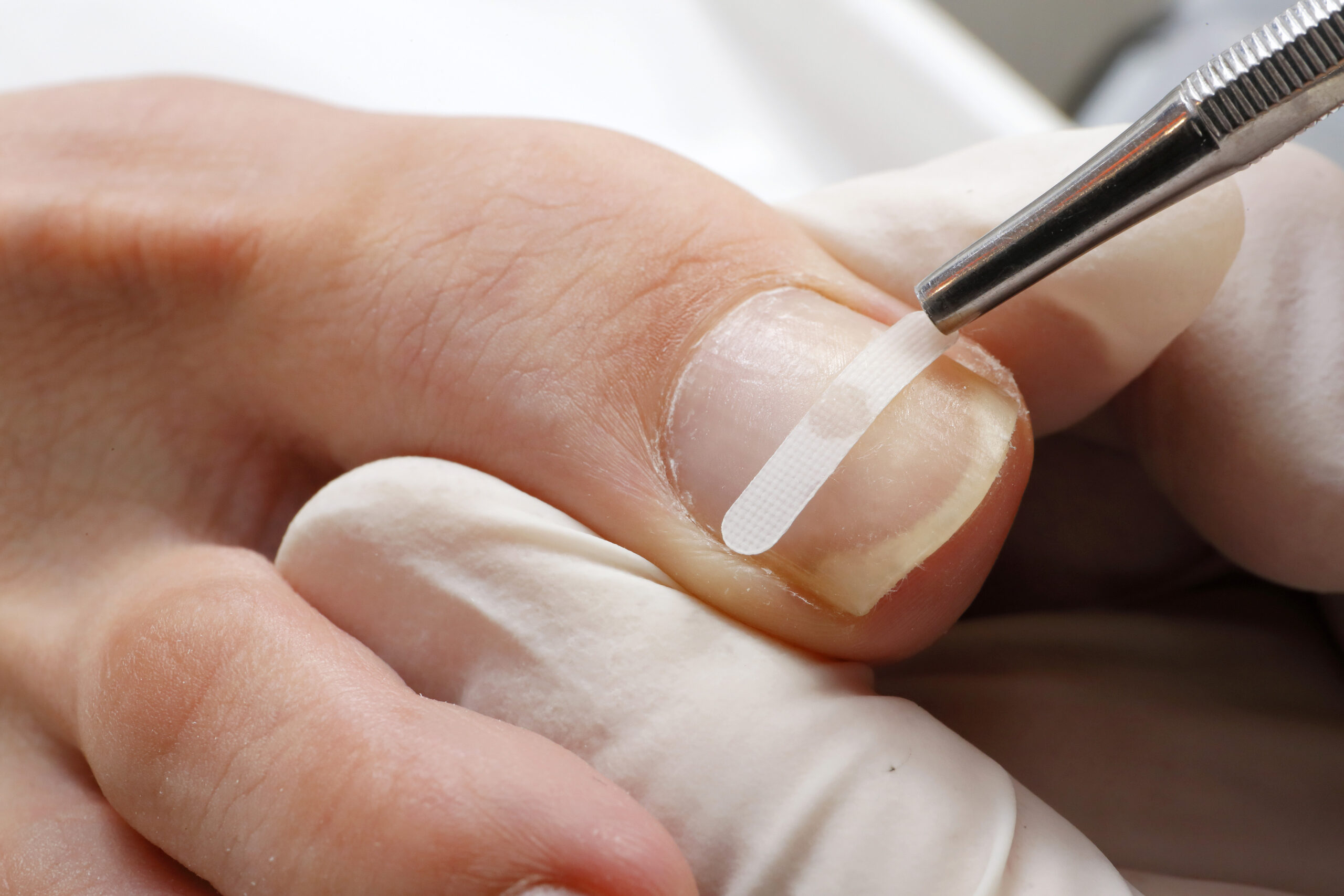 平塚市 巻き爪 プレート