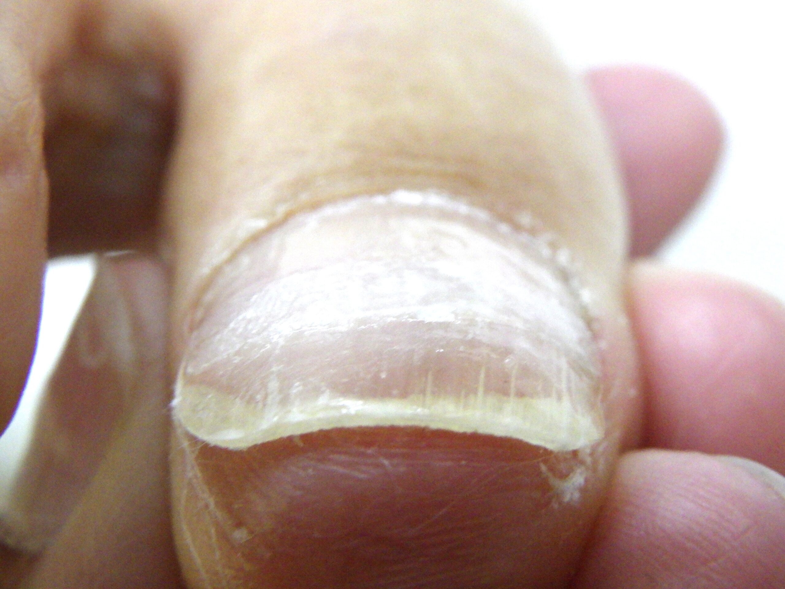 平塚市　巻き爪　アフター