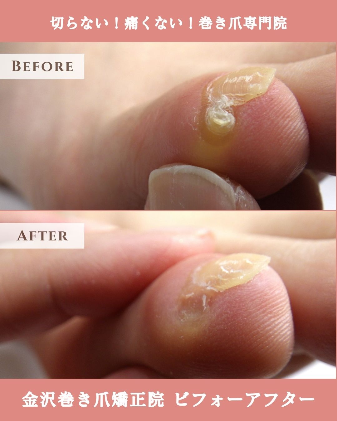 平塚市　巻き爪　副爪