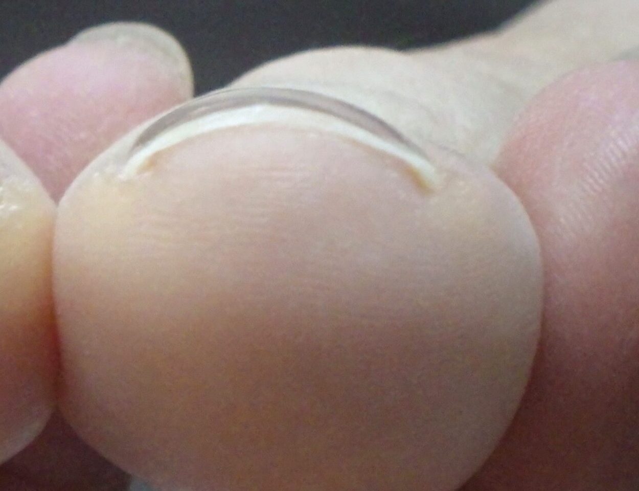 平塚市　巻き爪　アフター