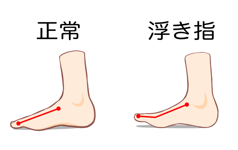 巻き爪　町田　浮き指