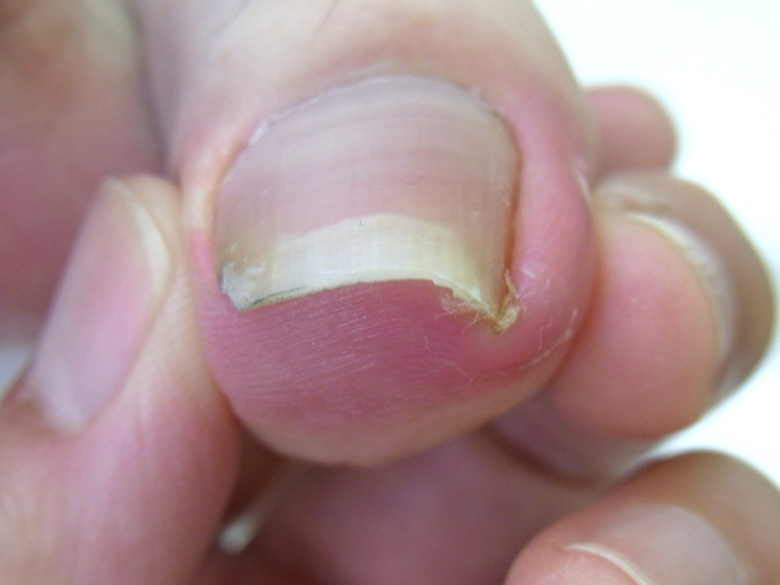 町田市　巻き爪　ビフォー