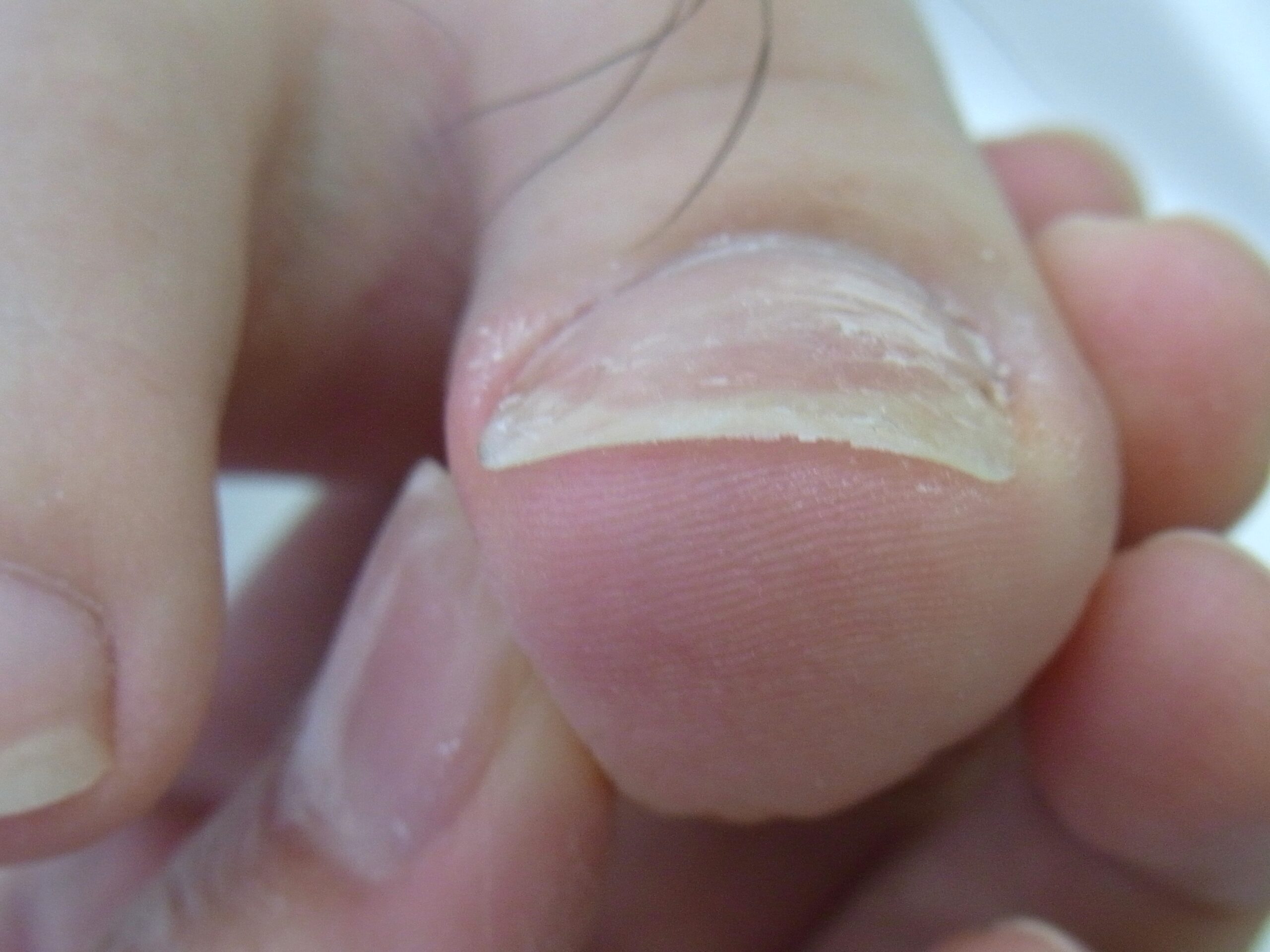 町田市　巻き爪　アフター