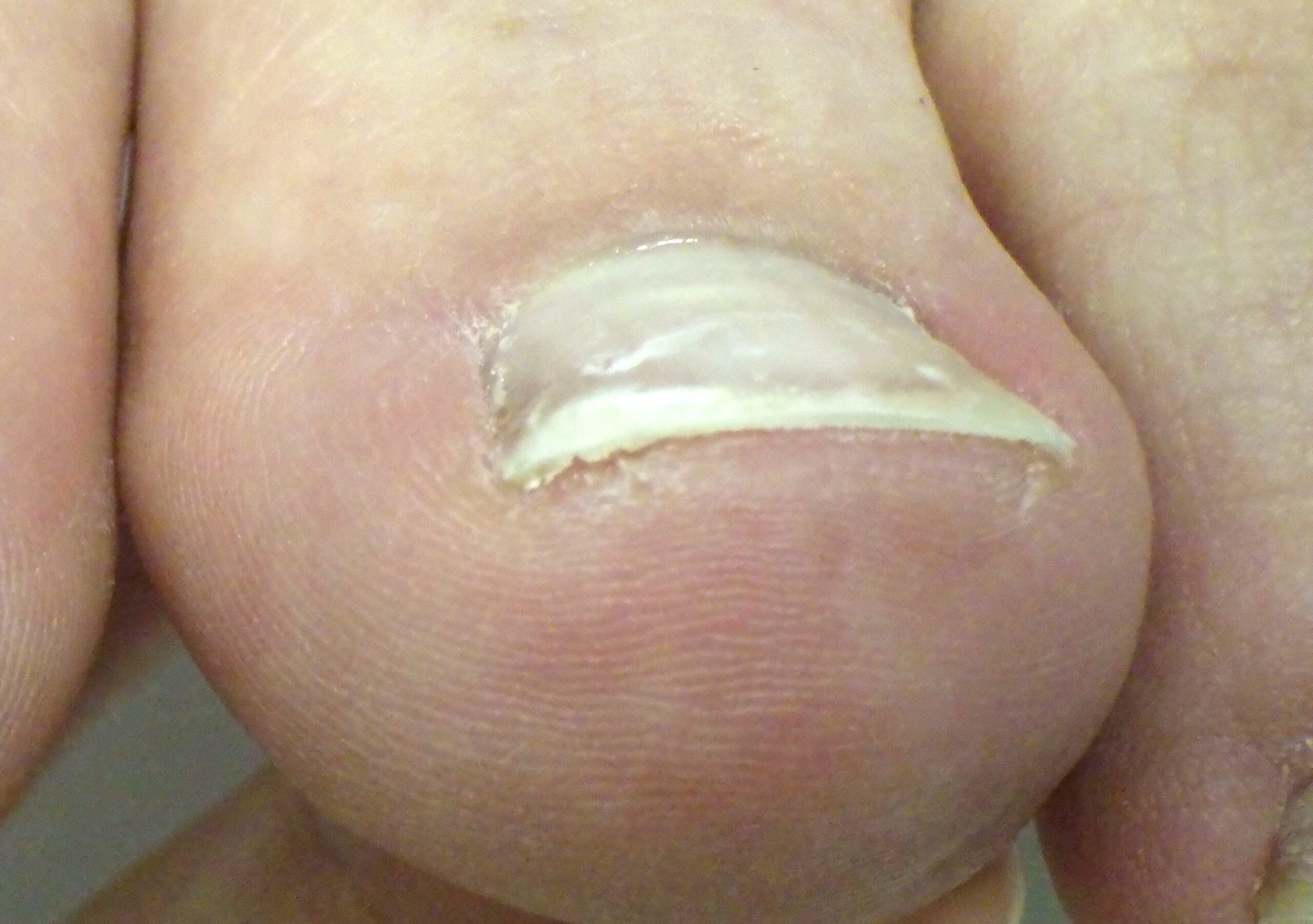 町田市　巻き爪　アフター