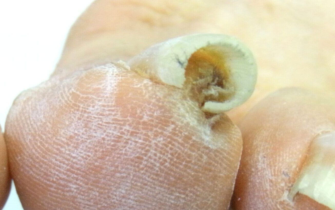 町田市　巻き爪　ビフォー