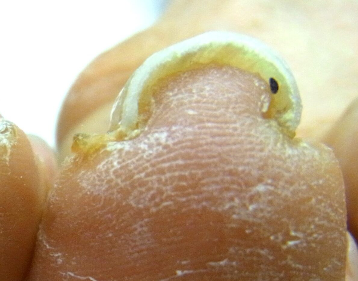 町田市　巻き爪　アフター