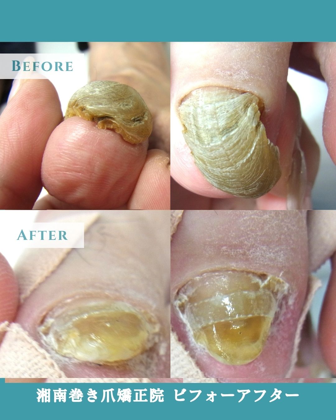 町田市　巻き爪　変形爪