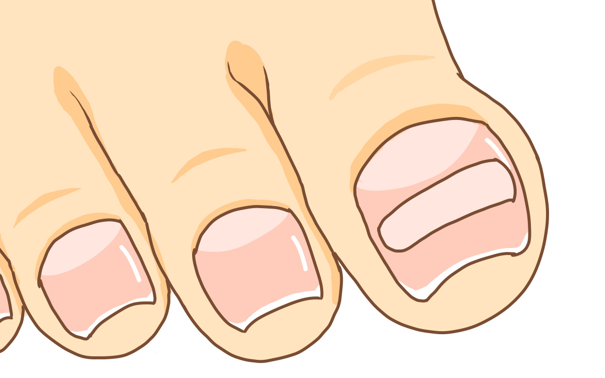 町田市　巻き爪　プレート