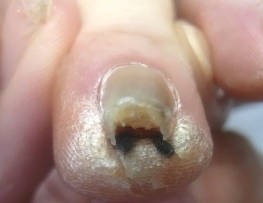 大船 巻き爪 ビフォー