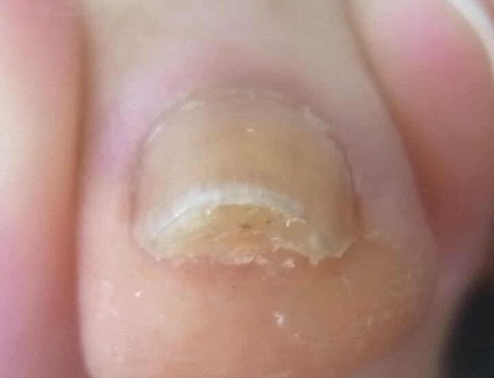 大船 巻き爪 アフター