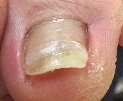 大船　巻き爪　アフター