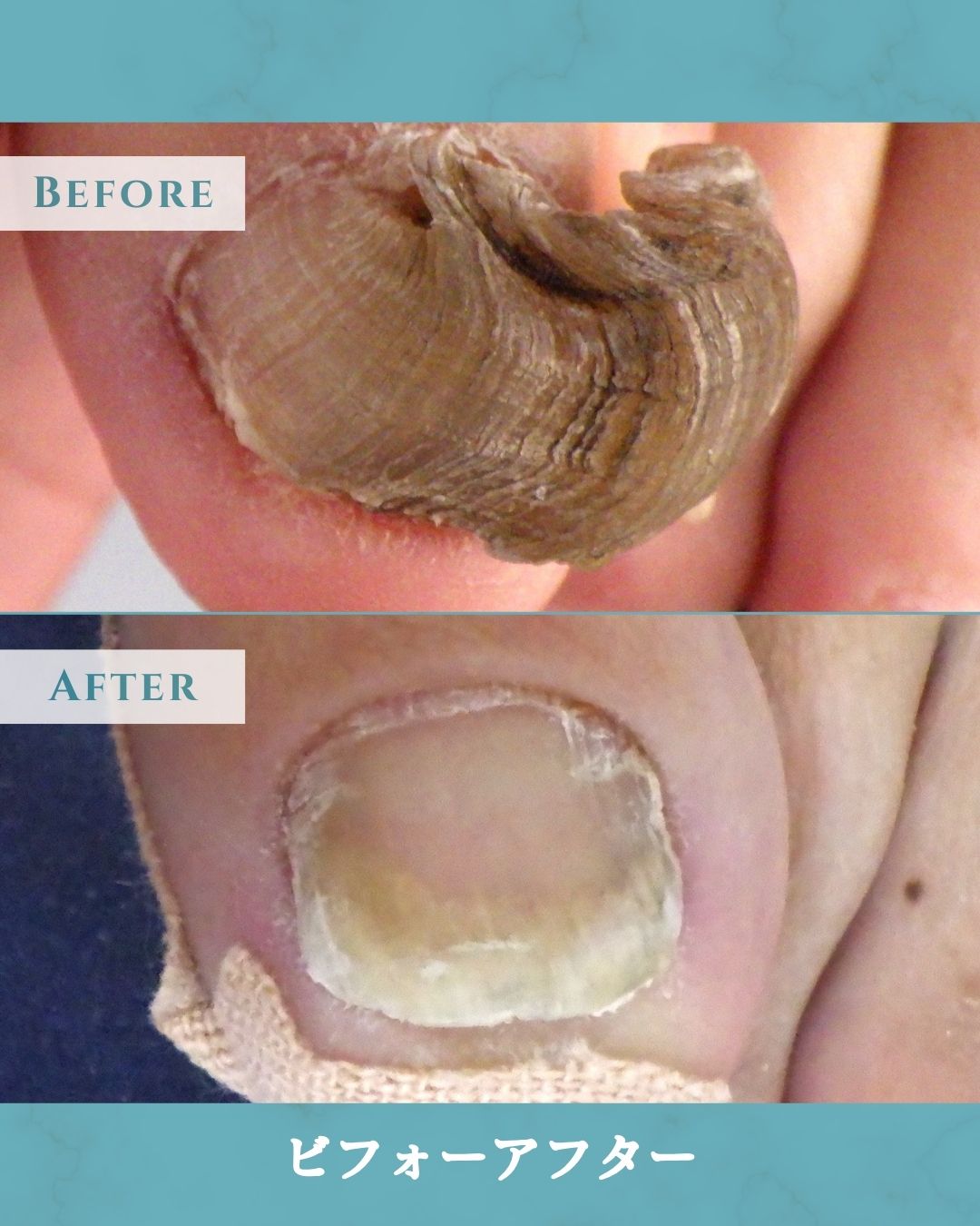 大船　巻き爪　変形爪