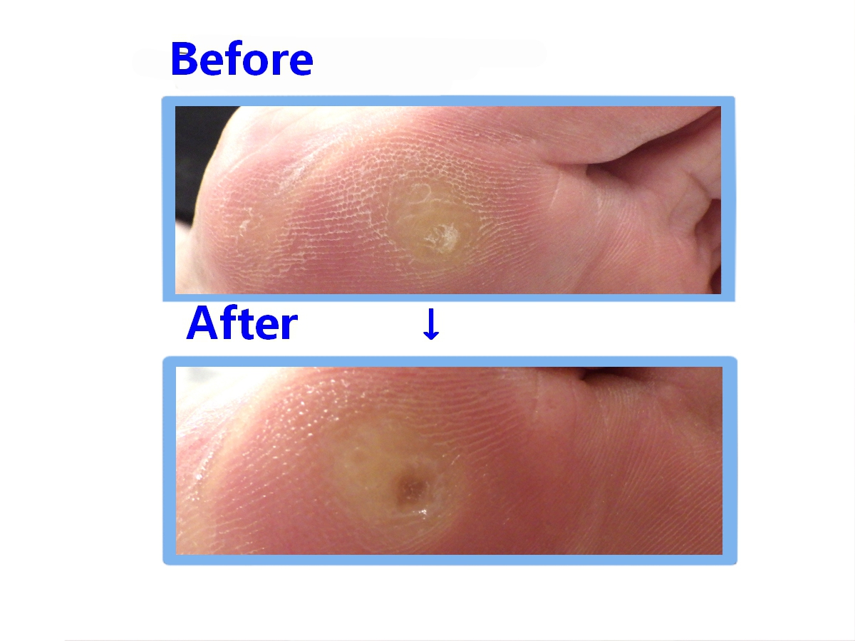 大船　巻き爪　ビフォーアフター