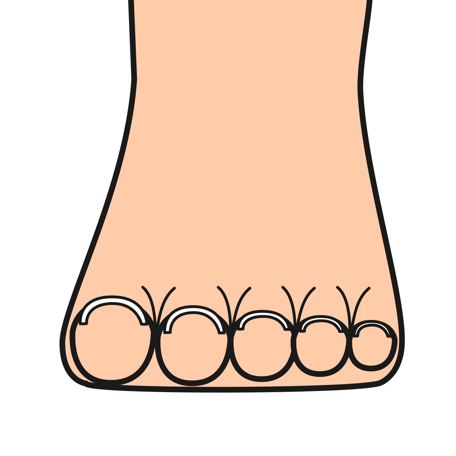 大船　巻き爪　開張足