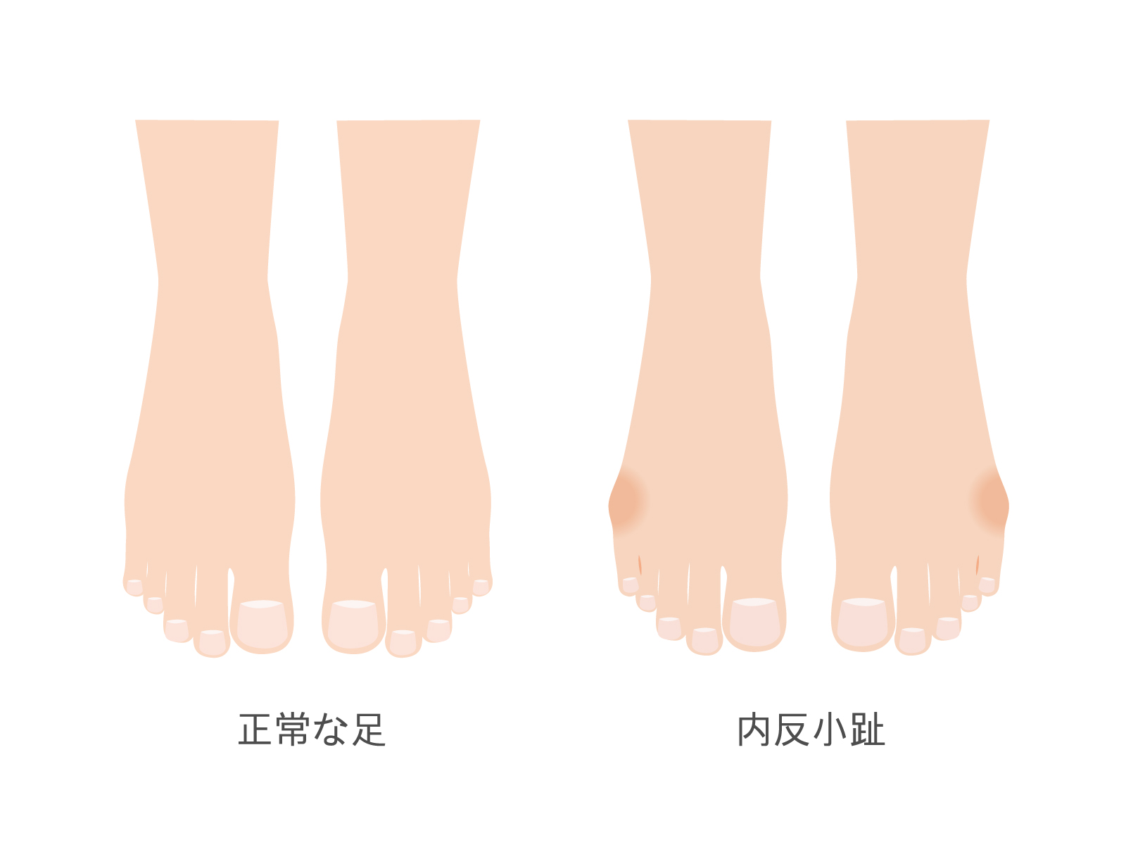 相模大野　巻き爪　内反小趾