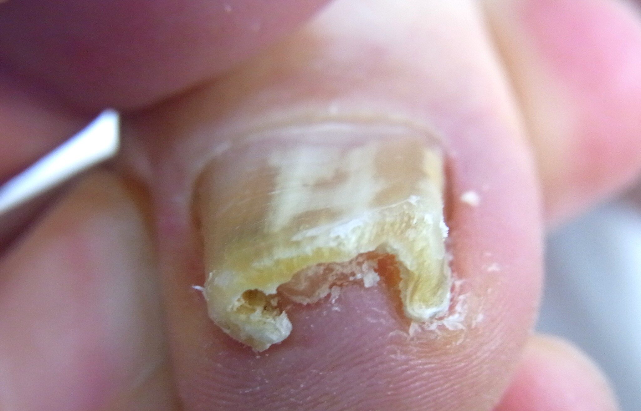 相模大野　巻き爪　ビフォー