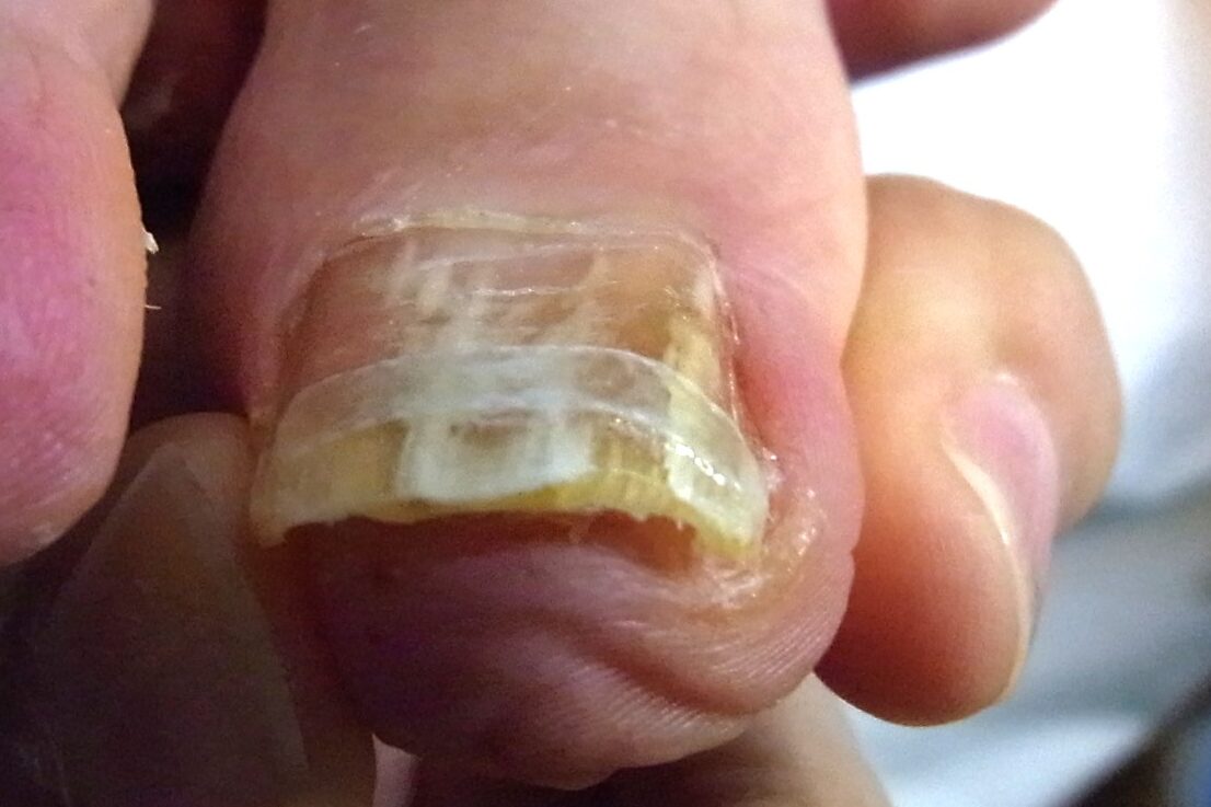 相模大野　巻き爪　アフター