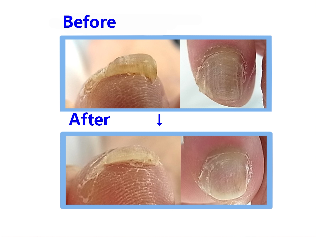 相模大野　巻き爪　ビフォーアフター