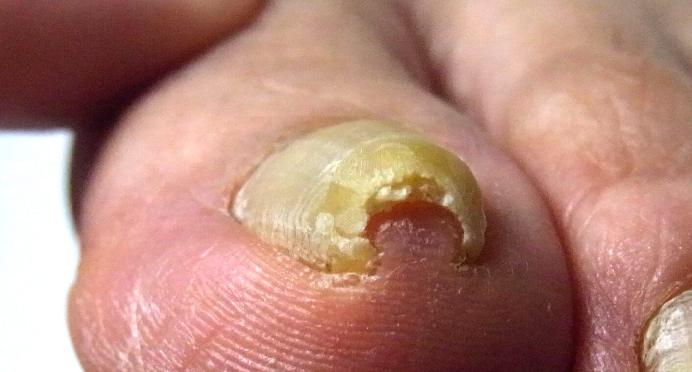 相模大野　巻き爪　ビフォー