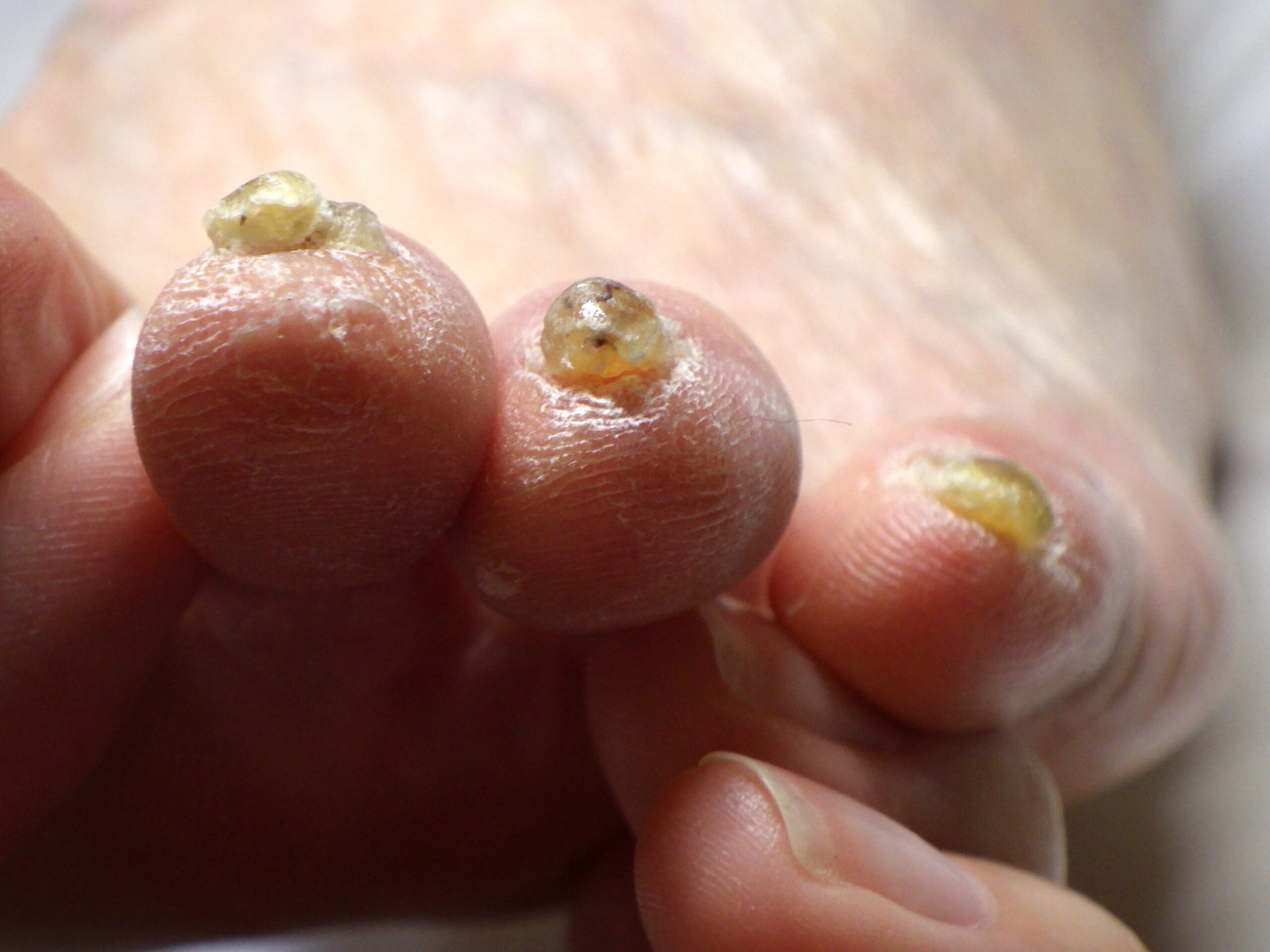 相模大野　巻き爪　ビフォー