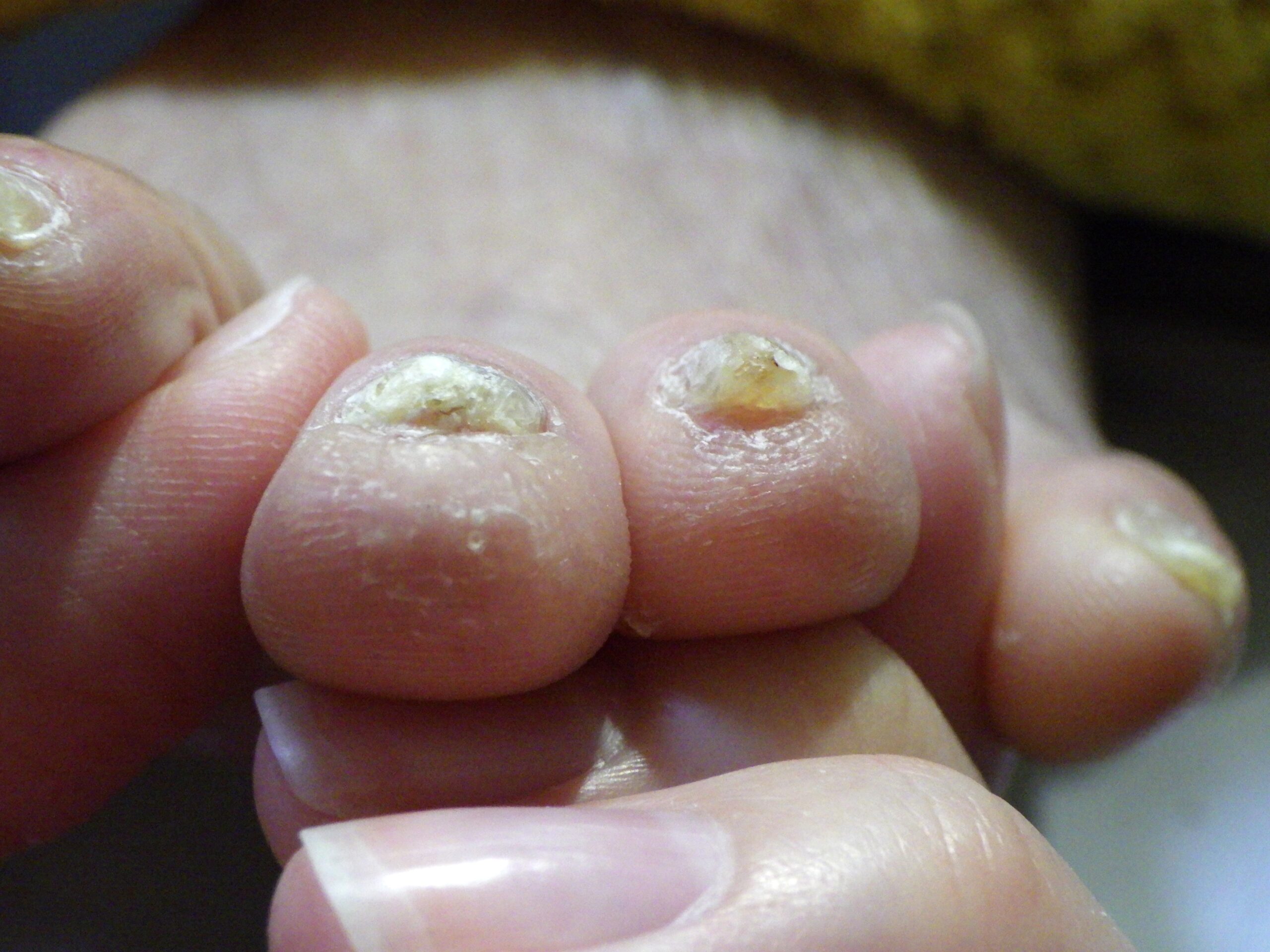 相模大野　巻き爪　アフター