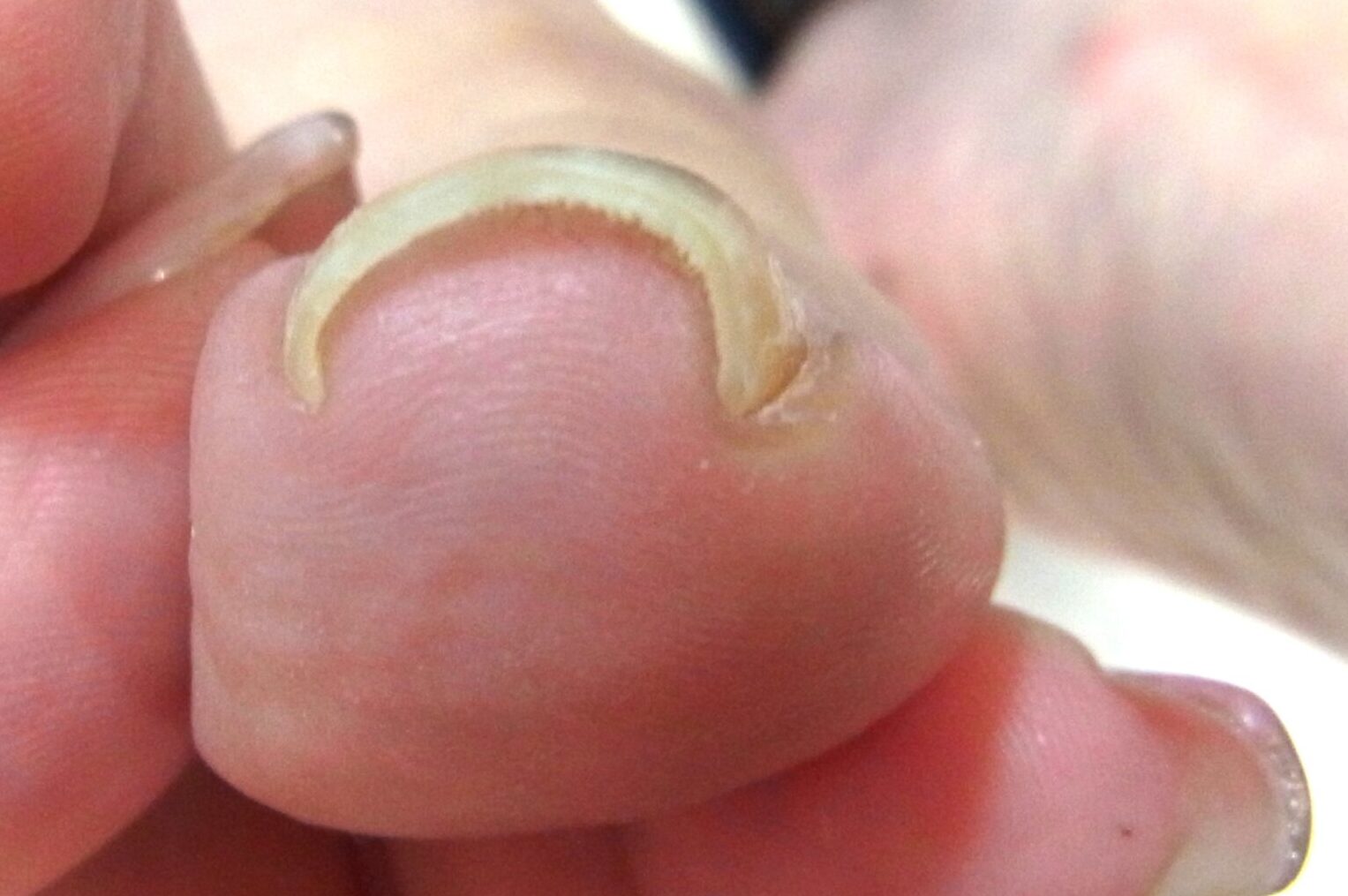 大和市 巻き爪 ビフォー