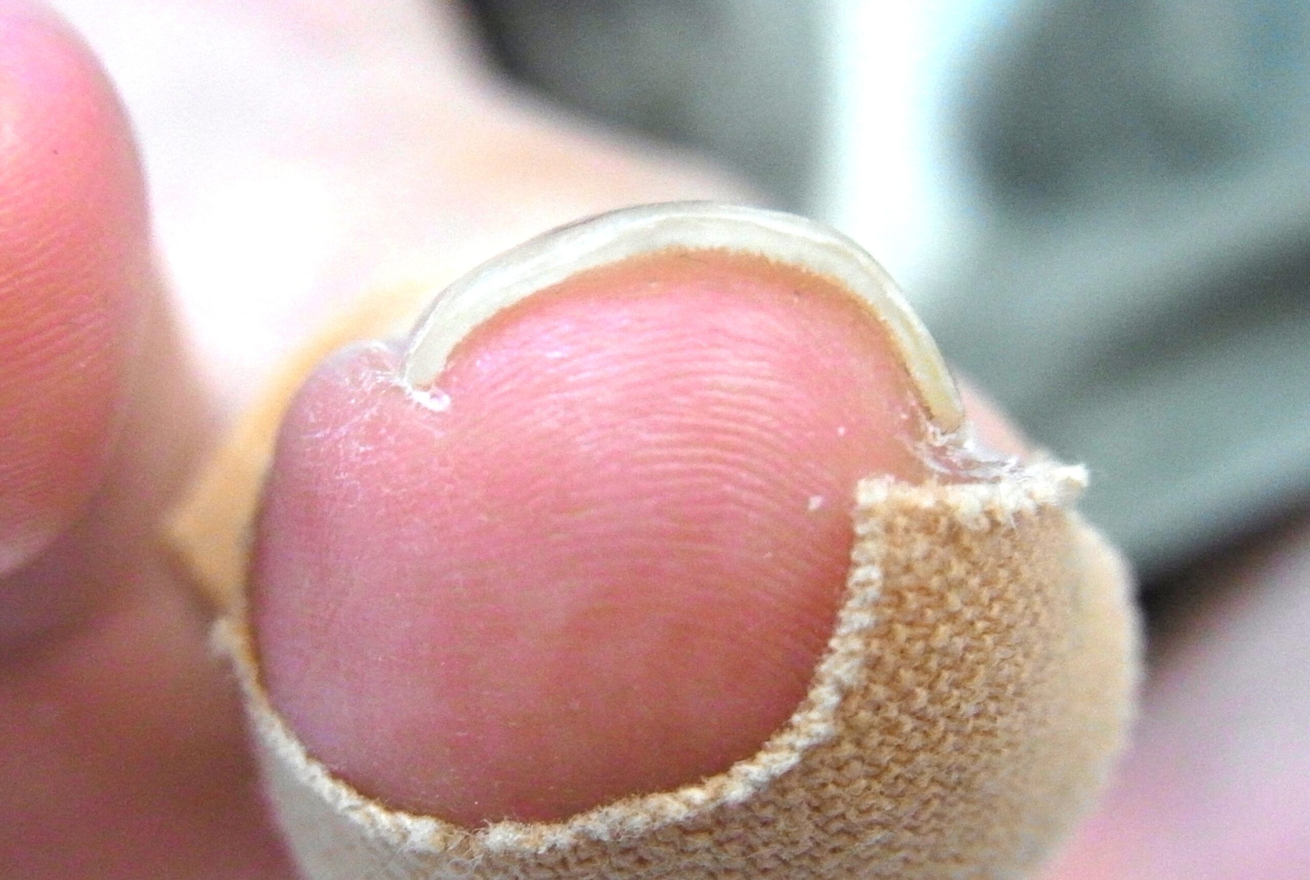 大和市 巻き爪 アフター