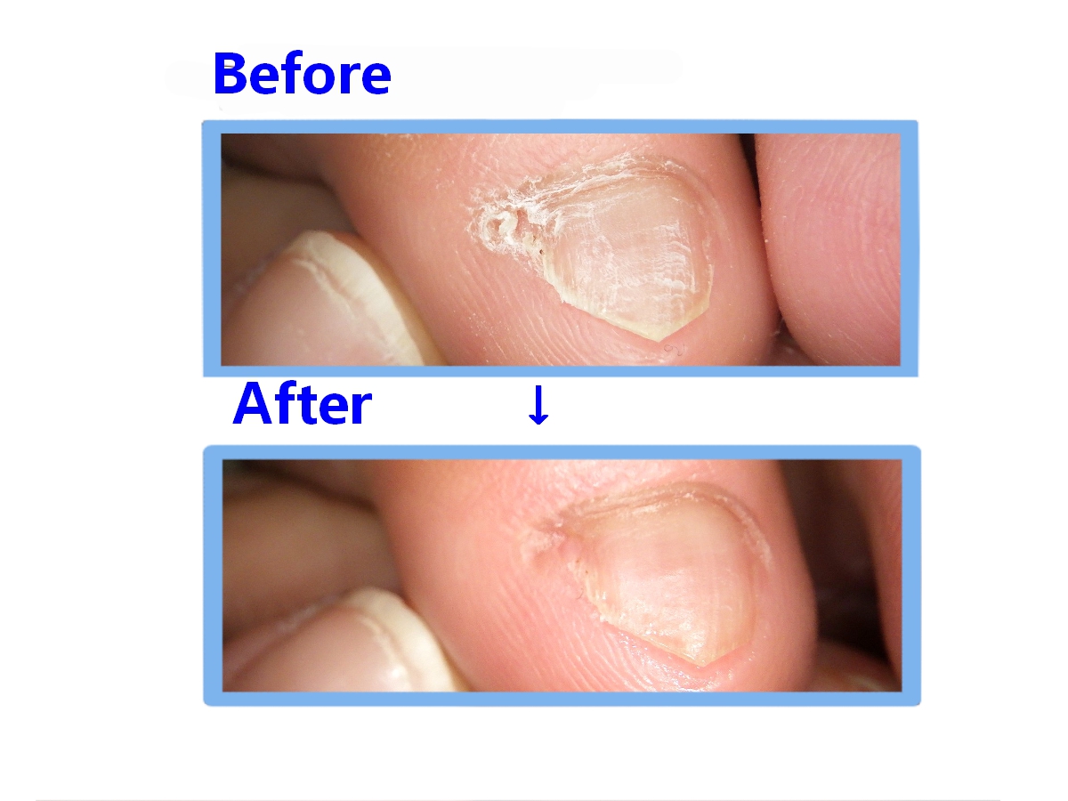 大和市　巻き爪　副爪