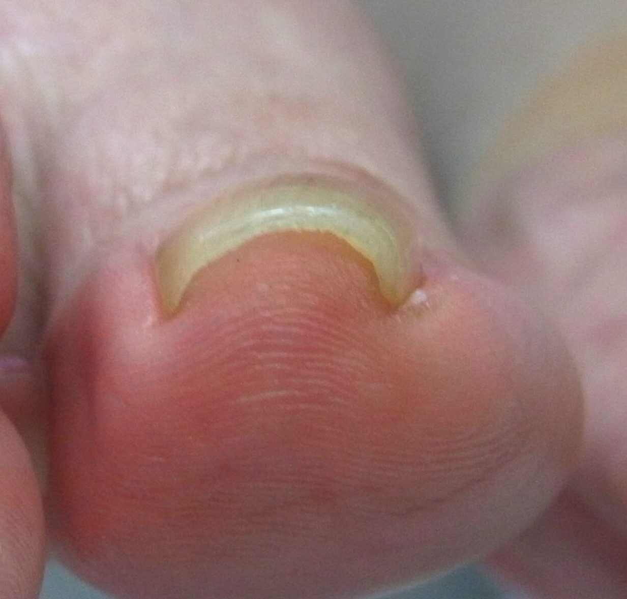 大和市　巻き爪　ビフォー