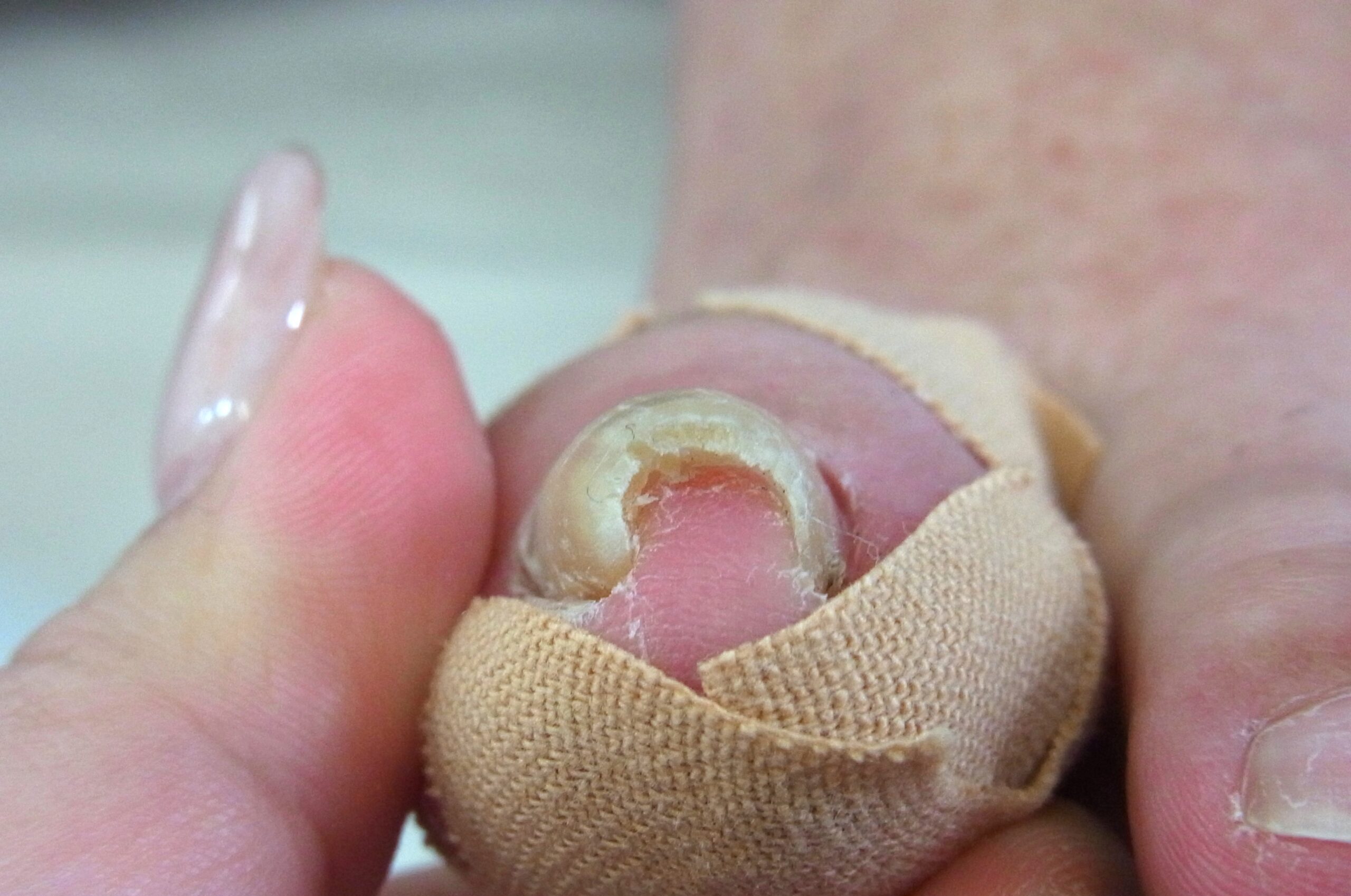 大和市 巻き爪 ビフォー