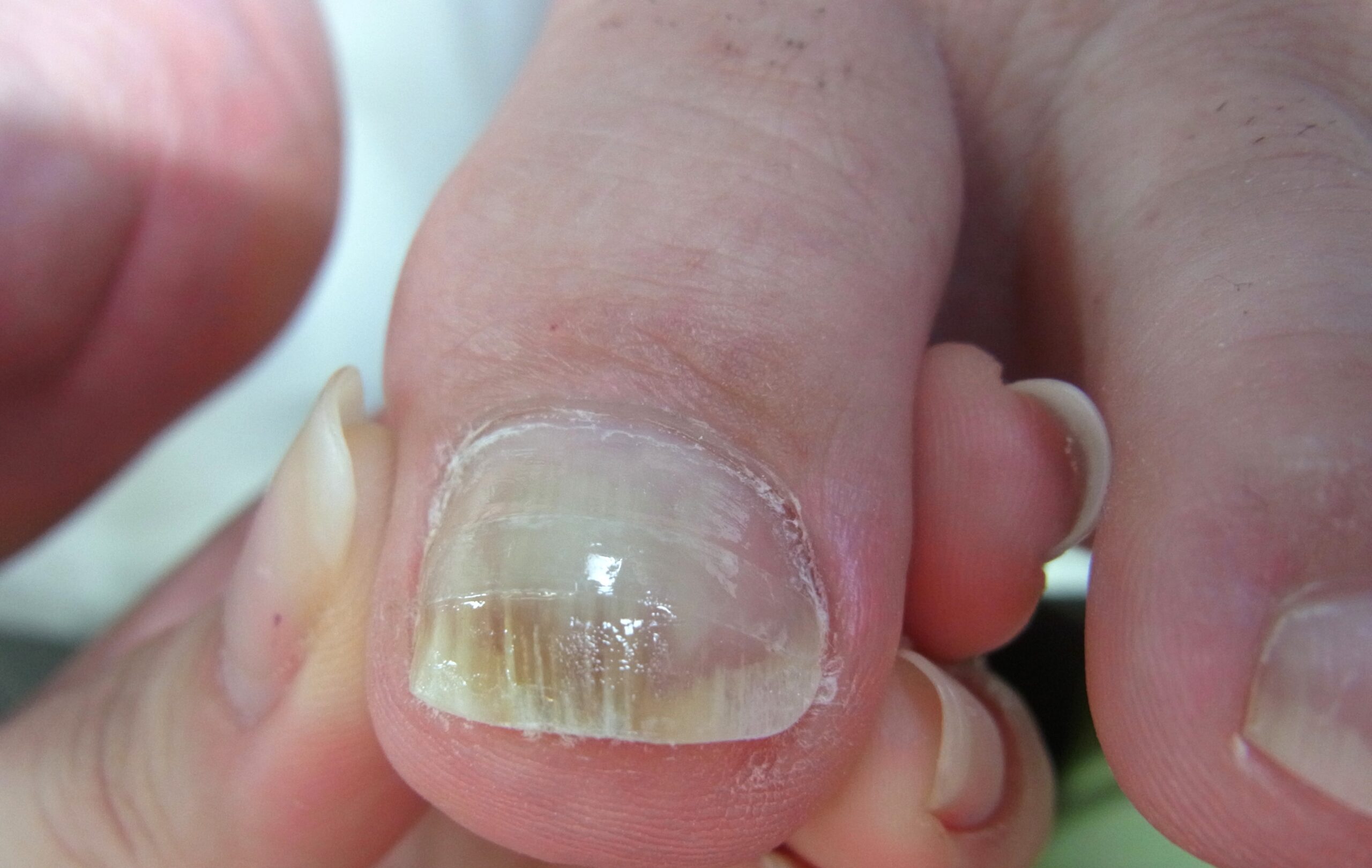 大和市 巻き爪 アフター