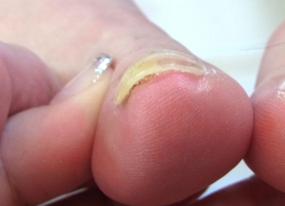 大和市　巻き爪　アフター