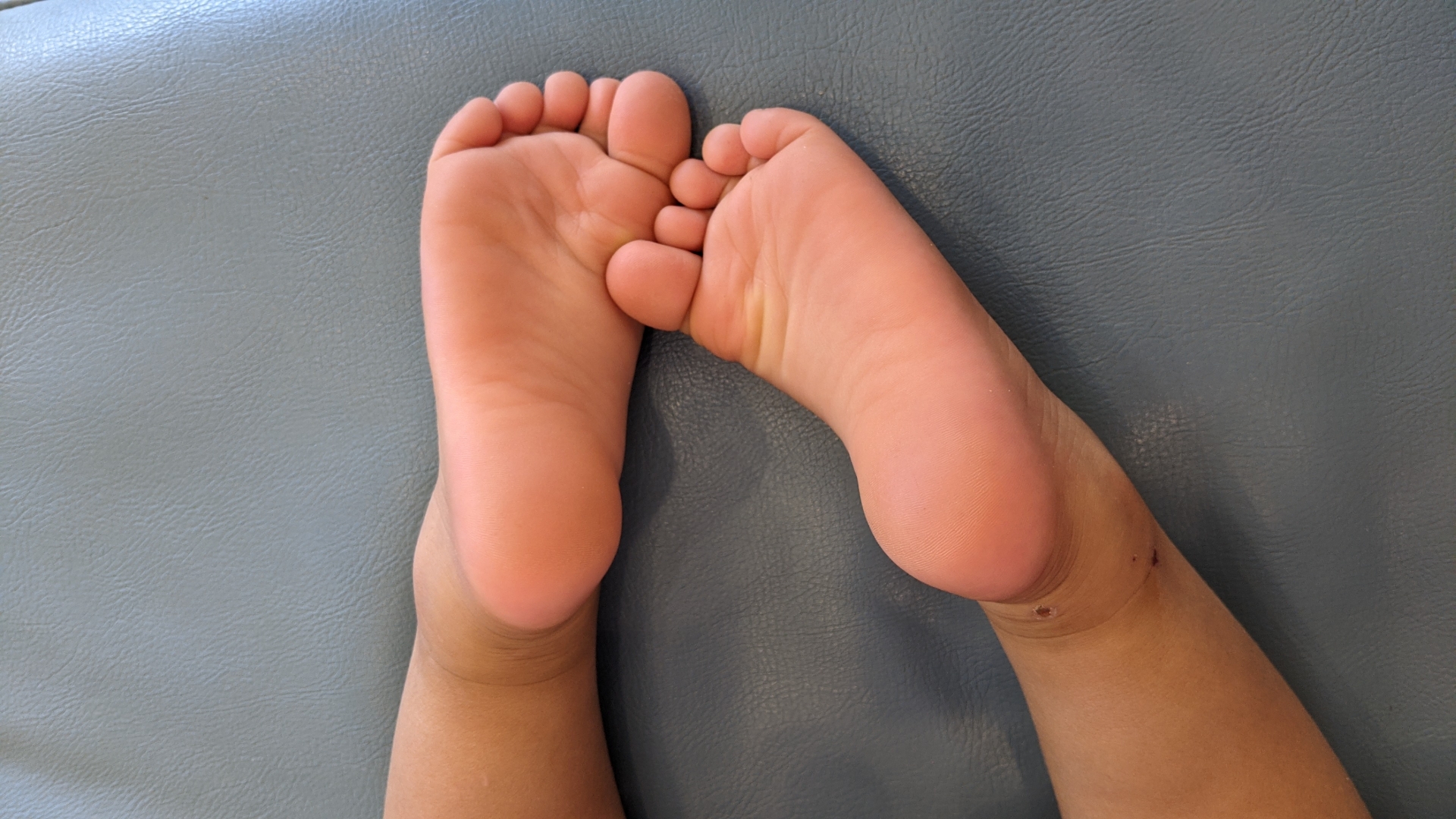 横須賀市　巻き爪　子供の足