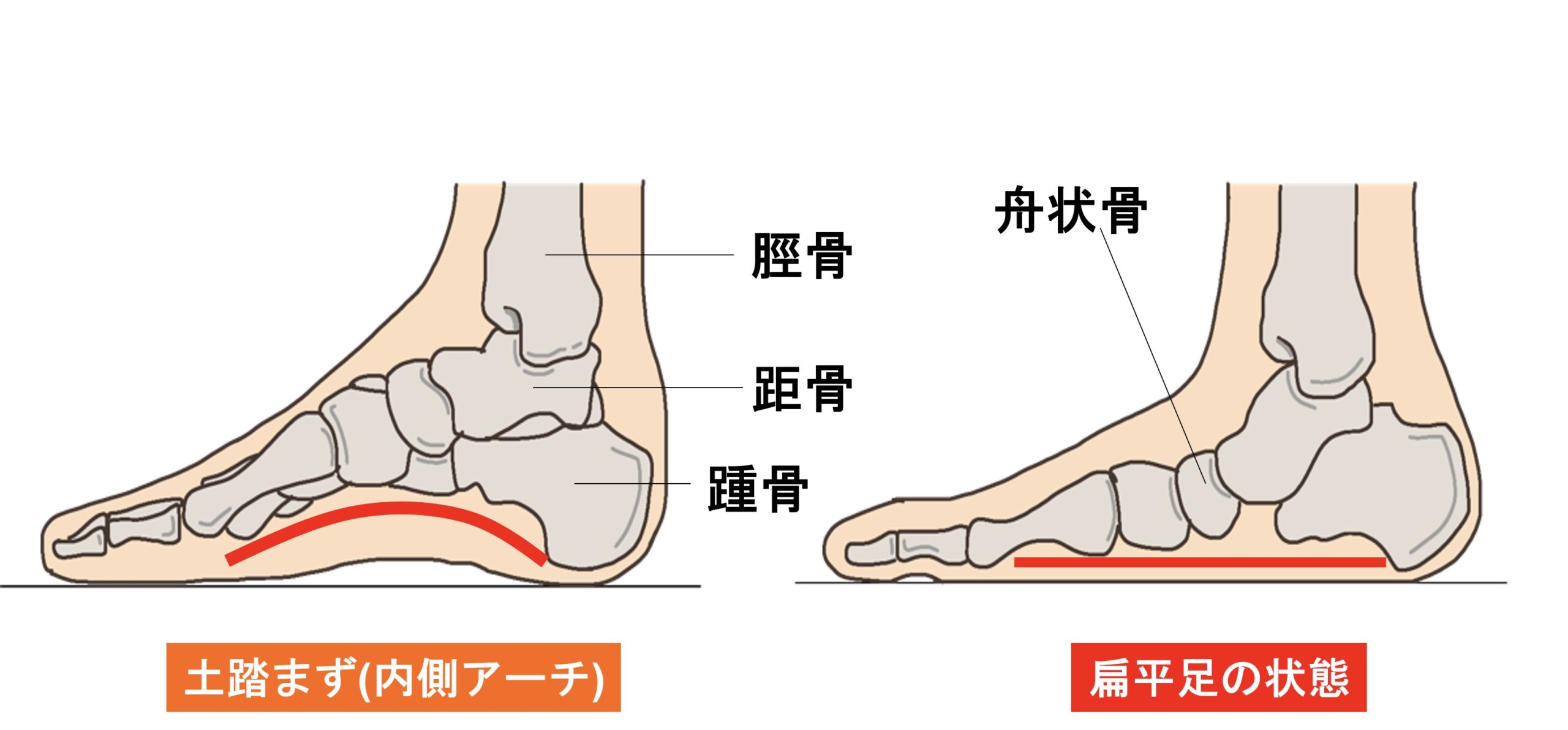 横須賀市　巻き爪　扁平足