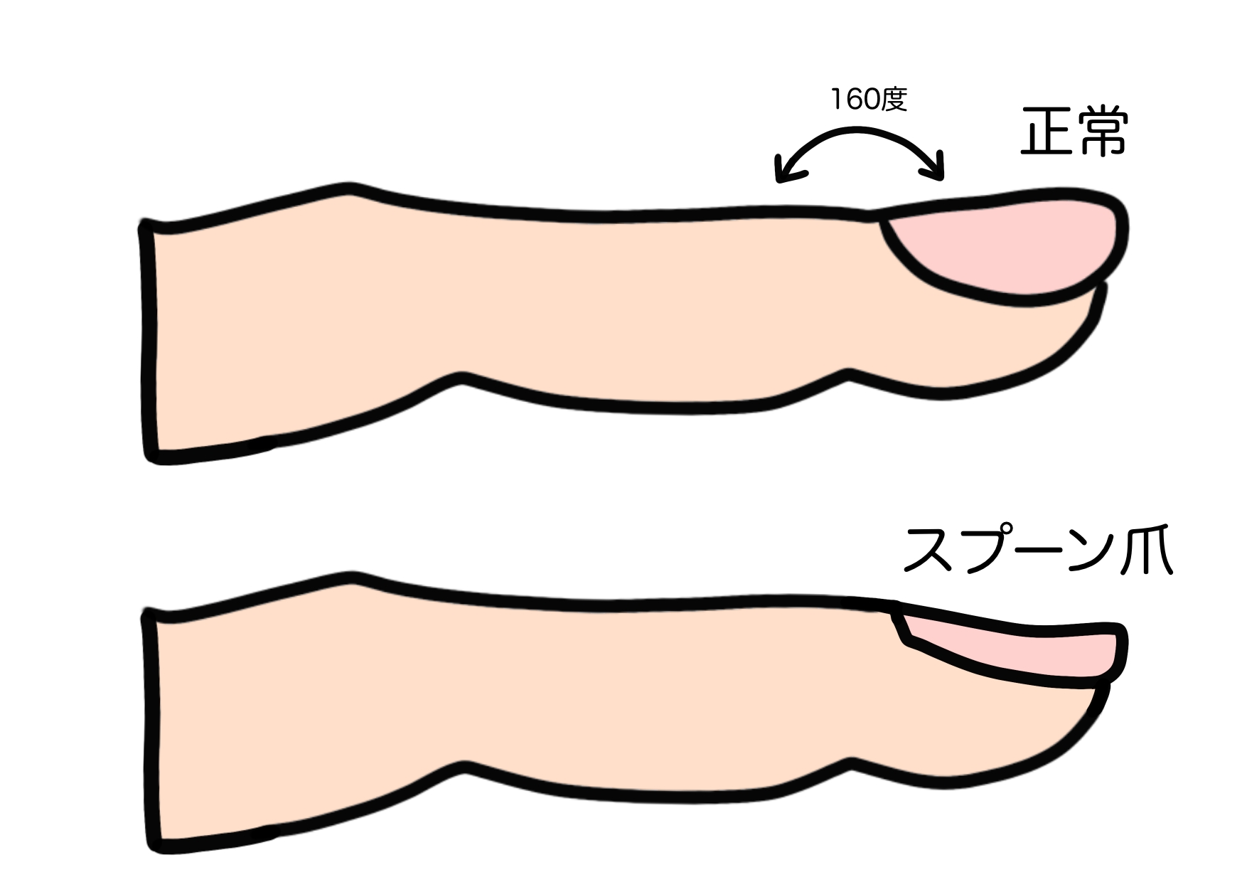 横須賀市　巻き爪　スプーン爪
